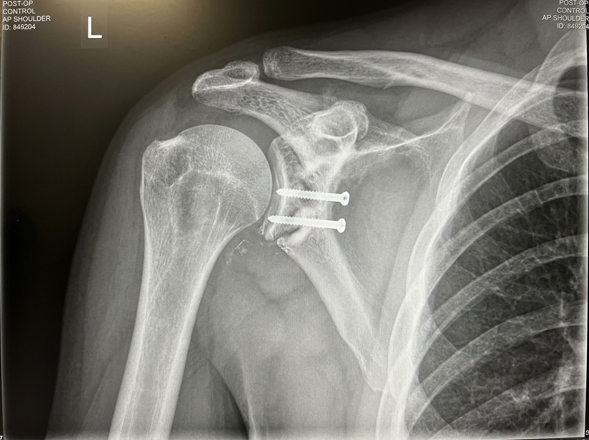 X ray after Latarjet procedure 20261025173341